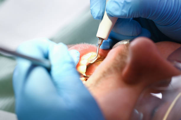 Best Emergency Dental Care for Broken or Chipped Teeth in Bellevue, KY